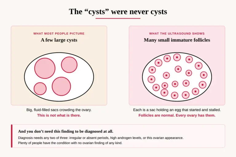 Diagram comparing ovarian cysts with immature follicles to explain the PCOS name change